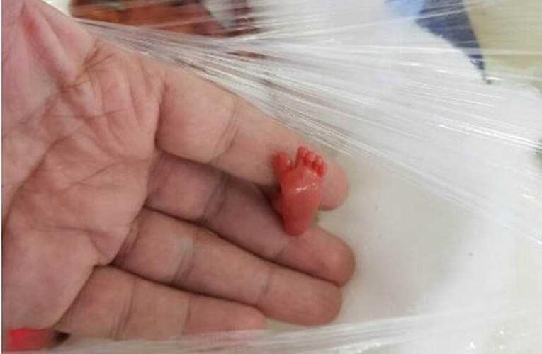 Rođena je sa 400 grama i bila je veličine dlana, lekari joj nisu davali NIKAKVE ŠANSE: Šest meseci kasnije desilo se ČUDO!
